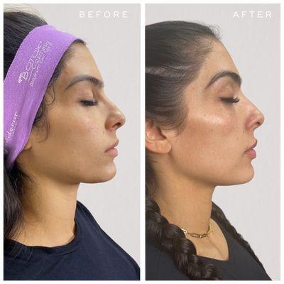 Before and after skinvive