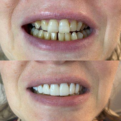 Discolorated teeth before/after