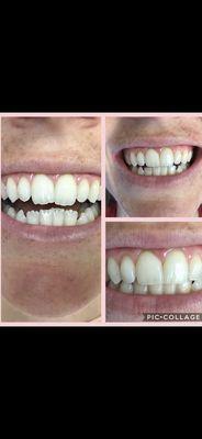 20min procedure to reshape this beautiful patients smile.