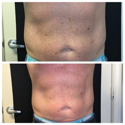 Before and after only 1 session under the UltraSlim light! More definition in only 20 minutes!