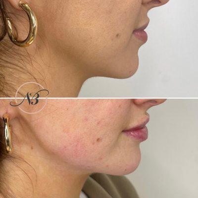 Jawline augmentation by Nurse K to create a more defined look