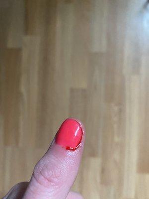 1 of 4 bleeding cuticles