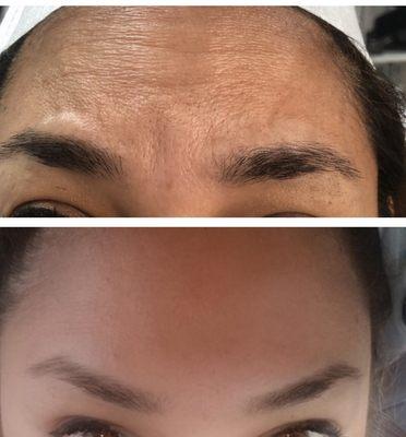 BOTOX BEFORE AND 2 WEEKS AFTER