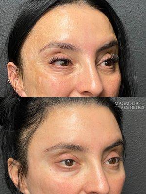 5 weeks after Botox for rejuvenation and wrinkle prevention and custom skincare protocol for melasma.