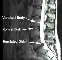 Treat herniated discs with non-surgical spinal decompression