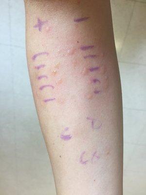 Arm marked up for allergy test