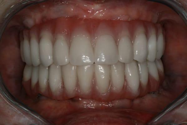 Final All-on-Four teeth created by one of the world's best technicians.  A perfect smile and perfect bite - teeth that STAY IN!