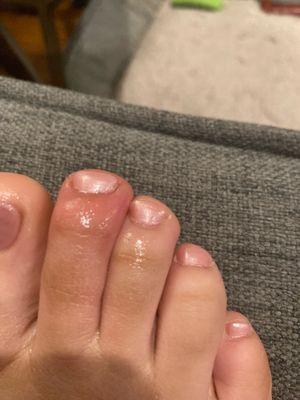 Toes infected by the pedicure technician at Lin's nails. Never ever happened before.