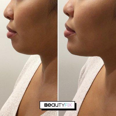 With our #ChinFix treatment, we use a small amount of filler to improve projection & create harmony in your overall appearance.