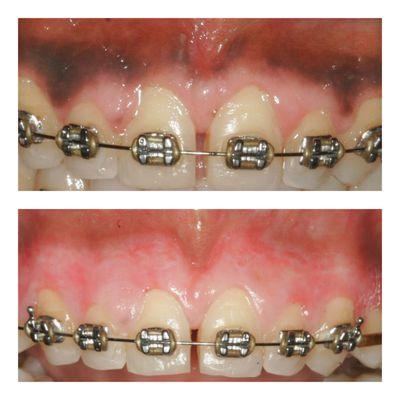 Gum Bleaching Before and After