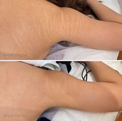 Before & After - 3 sessions - Stretch Mark Camouflage