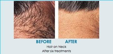 With 3 different lasers for hair removal, TLC has the right laser for every skin type.