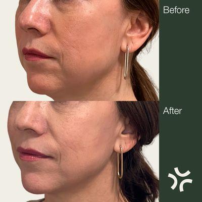 Before and after Image. This patient had a single session of fat dissolving injections along the jawline and under the chin.