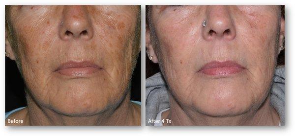 IPL laser resurfacing.