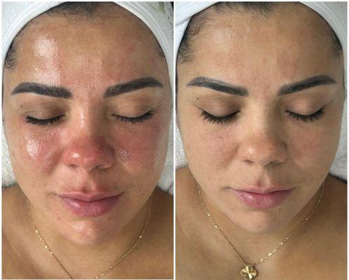 After and Before- B&B Spa Custom Signature Facial