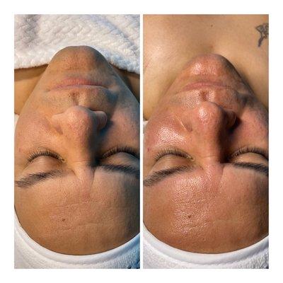 Before/after mens HydraFacial