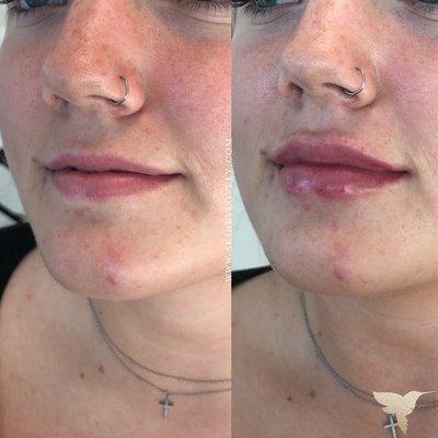 Lip filler before and after by Jessie Barron RN at Skin by Lovely Lake Oswego