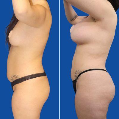 Breast Augmentation, liposuction, and fat transfer to buttocks 'BBL'- Dr. Stompro