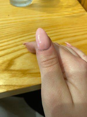 Misshapen nail