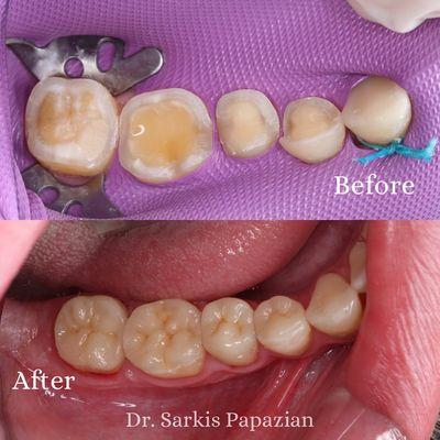 Recreating natural tooth structure with composite fillings