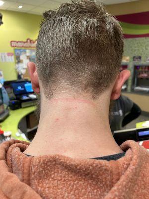 The razor burn or something on his neck. He also has a few nicks on the side of his neck