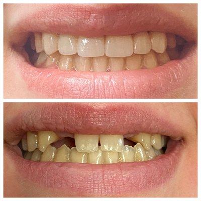 Patient wasn't born with her front two teeth. Great Cosmetic Case to recreate a Beautiful Smile. Patient was very happy with the result.