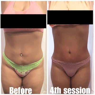 Body sculpting and cavitation treatment