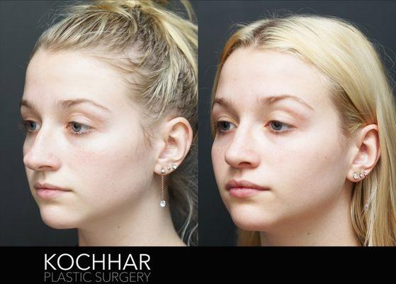 Before and After Rhinoplasty