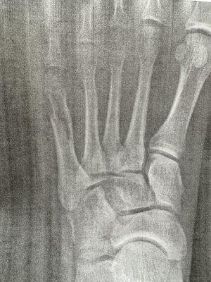 Fractured 5th Metatarsal