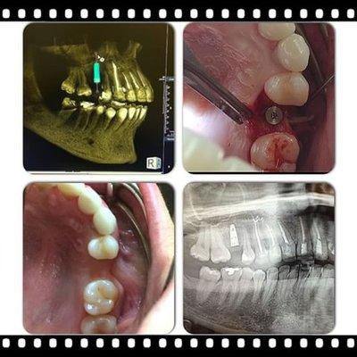 Successful single Implant placement on tooth #4 area with CBCT-(cone beam imaging)