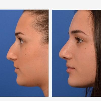 Rhinoplasty