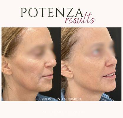 Potenza results for skin tightening, texture, fine lines, and jowls