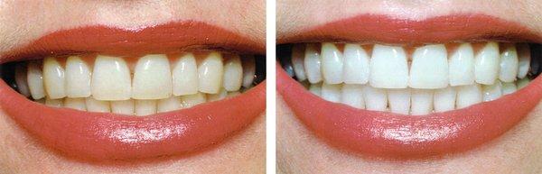 Teeth whitening