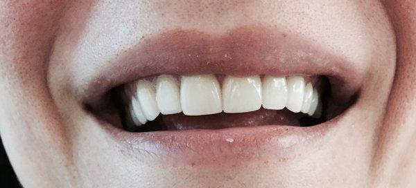 Porcelain Veneers by Dr. Sherri Bluth