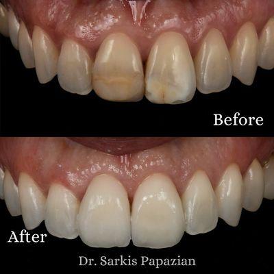 Transforming Smiles with Veneers: