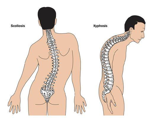 Get your posture checked!