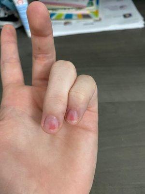 The only two fingers he worked on were left with burns. I am in severe pain.