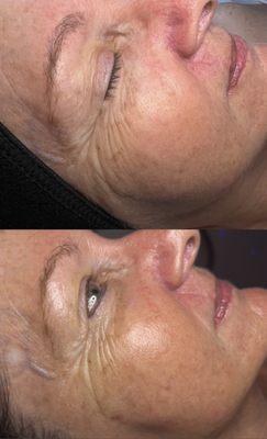 Anti-Aging Facial