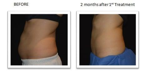 CoolSculpting Before & After