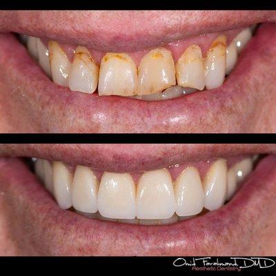 6 porcelain veneers to completely rehabilitate a neglected mouth and smile