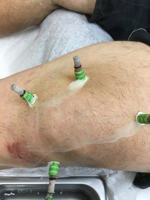 Knee pain Moxibustion(Moxa).