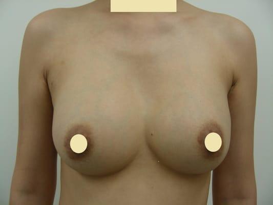 3 months after breast augmentation.