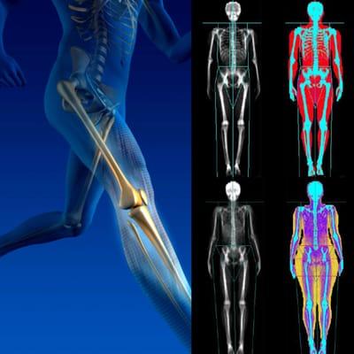 DXA/DEXA Bone Density and Body Fat Composition Scan