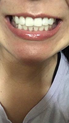 My after Zoom Whitening. Every penny is worth the beauty!