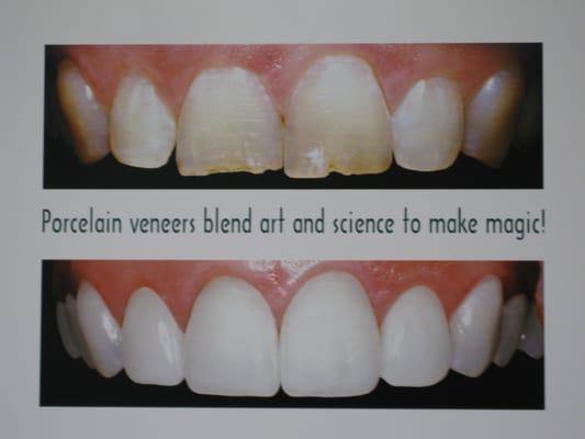 Porcelain Veneers