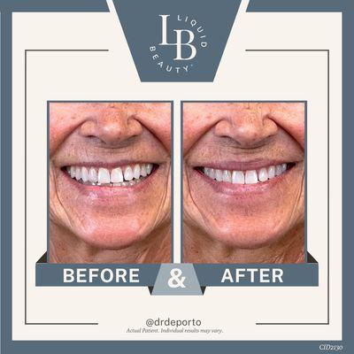 I love this transformation!  A combination of a Botox lip flip and Juvederm Volbella lip filler gave her upper lip a gorgeous boost!