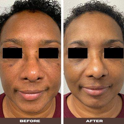 Before & after medical grade skincare and Clearlift x 4