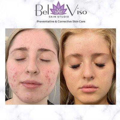 Acne treatments designed specifically for your skins needs!