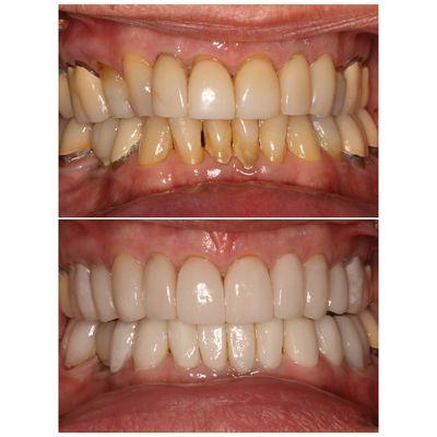 Porcelain veneers