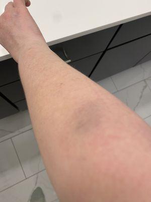 Bruises resulting from Jeff McClure's physical contact